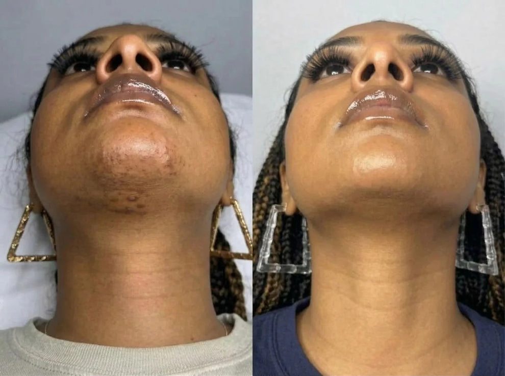 Cyperus Rotundus Skin Serum - Stop Unwanted Hair Growth Naturally - 100% Real [Buy 1 Get 1 Free]