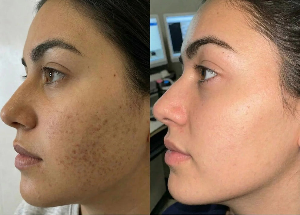 Cyperus Rotundus Skin Serum - Stop Unwanted Hair Growth Naturally - 100% Real [Buy 1 Get 1 Free]